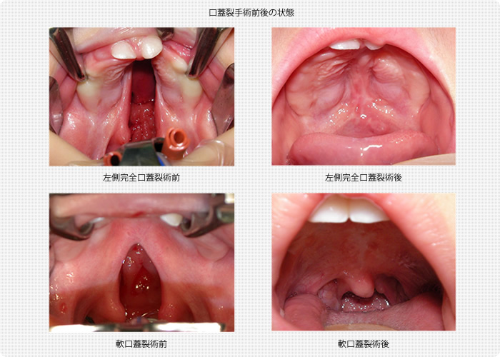 口蓋裂手術前後の状態