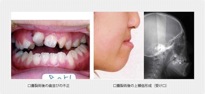 口蓋裂に伴う歯並びの不正、上顎の低形成（受け口）