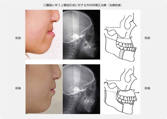 口蓋裂に伴う上顎低形成に対する外科的矯正治療（治療前後）
