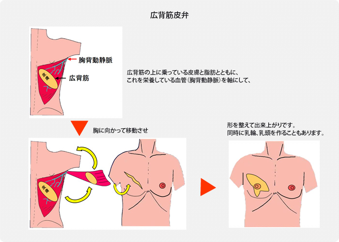 森の雑貨屋さん 【裁断済み】形成外科 人工物による乳房再建のリカバリー 通販