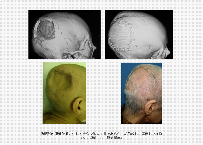 後頭部の頭蓋欠損に対してチタン製人工骨をあらかじめ作成し、再建した症例