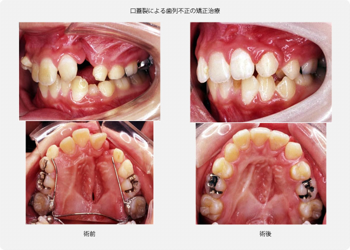 口蓋裂による歯列不正の矯正治療